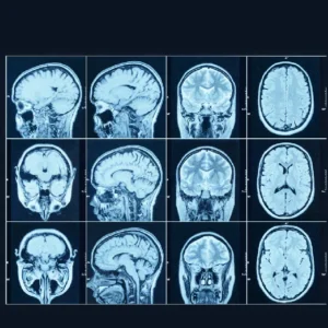 Brain PET-CT Scan
