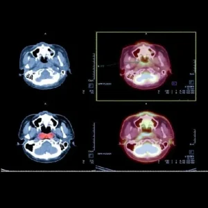 DOPA PET Scan