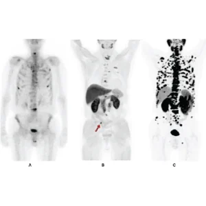 PSMA PET Scan